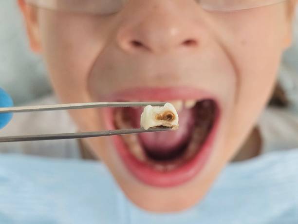 Best Emergency Dentist for Lost Fillings or Crowns in Chuluota, FL